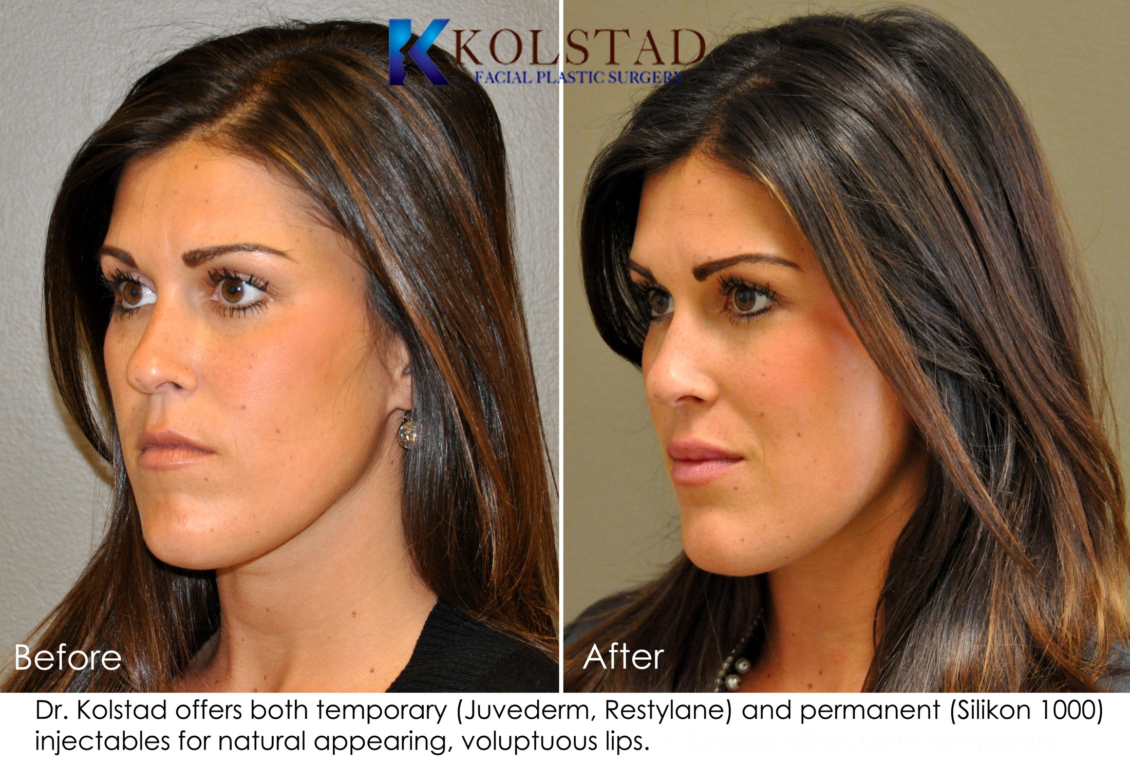 Lip Augmentation Before And After Gallery Dr Kolstad San Diego