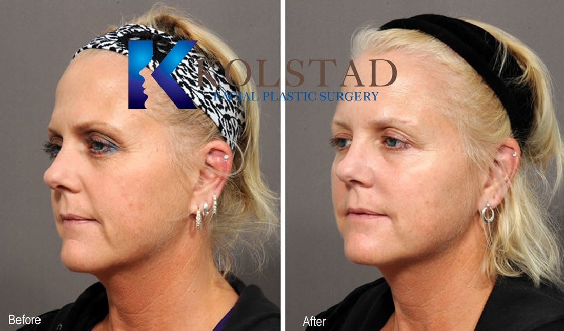 Juvederm, Restylane, Voluma, Vollure Facial Injectables
