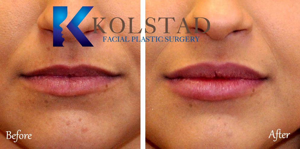 Add Volume with a Lip Augmentation - Folsom Ca - Nuance Cosmetic Surgery