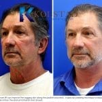 male face lift san diego 50