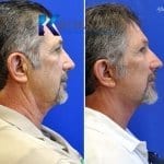 male face lift san diego 53