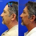 male face lift san diego 55