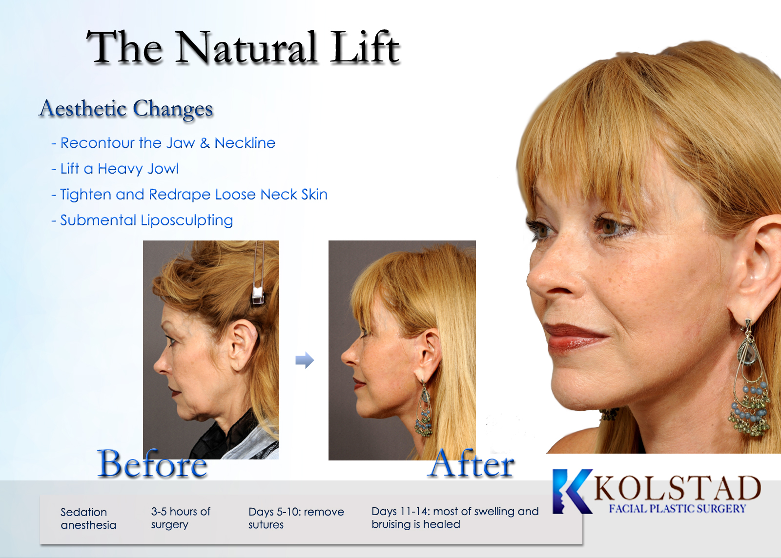 Facelift San Diego  Dr. Kolstad - San Diego Facial Plastic Surgeon