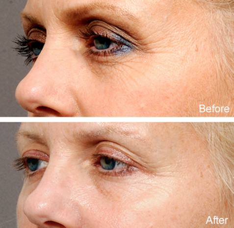news-blog-the-eyelid-aging-process-what-can-i-do-besides-surgery-sm