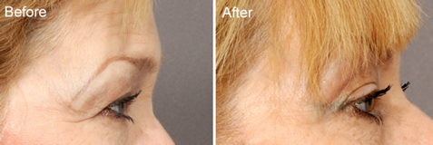 news-blog-the-eyelid-aging-process-what-can-i-do-besides-surgery