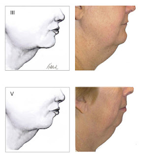 neck liposuction