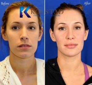 nose job before and after san diego la jolla