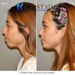 rhinoplasty before and after san diego la jolla