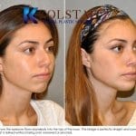 rhinoplasty before and after san diego la jolla