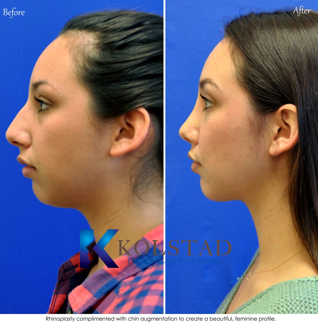 rhinoplasty san diego 5511 copy | Dr. Kolstad - San Diego Facial Plastic Su...