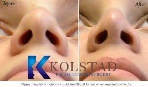 best scar after rhinoplasty