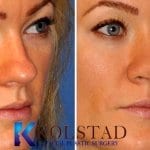 rhinoplasty before and after san diego top surgeon