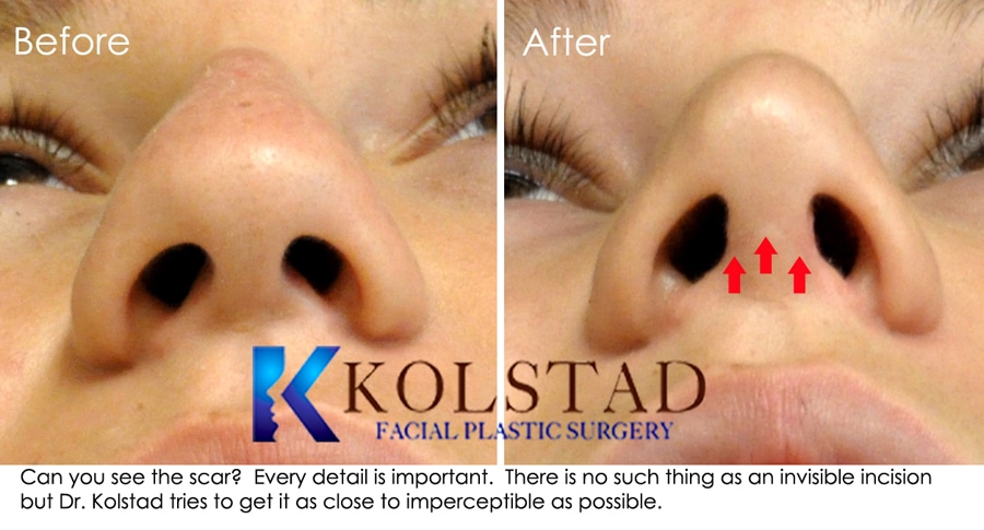 CO2 Laser San Diego  Dr. Kolstad - San Diego Facial Plastic Surgeon