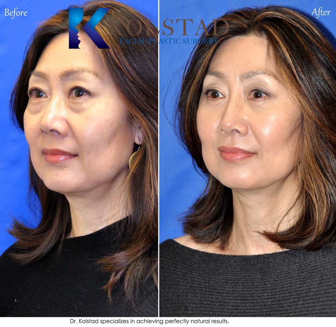 Milf Facial Before And After Telegraph