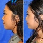 asian nose job surgery