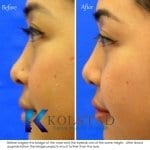 asian rhinoplasty natural results