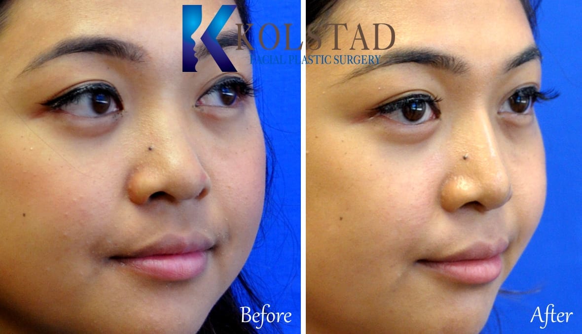 Asian Liquid Rhinoplasty Dr. Kolstad San Diego Facial Plastic