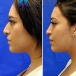 mexican rhinoplasty pictures before and after