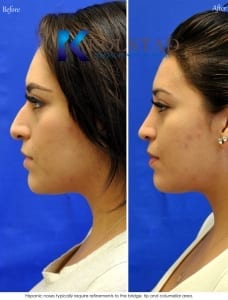 mexican rhinoplasty pictures before and after