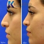 mexican rhinoplasty before and after