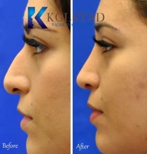 mexican rhinoplasty before and after