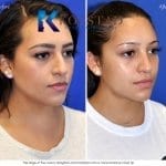 mexican rhinoplasty results