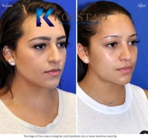 mexican rhinoplasty results