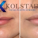 beautiful lip filler results
