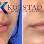 natural lip filler results
