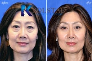 asian eyelid specialist lower blepharoplasty in san diego