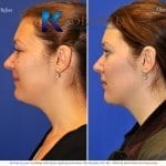 san-diego-neck-liposuction-144