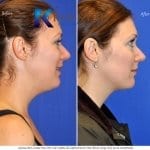 san-diego-neck-liposuction-145-copy