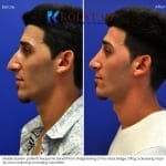 middle eastern rhinoplasty