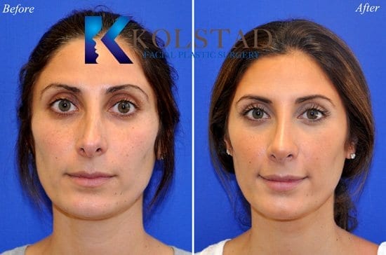 Revision Nose Surgery San Diego CA