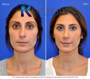 Middle Eastern Nose Job Before & After San Diego