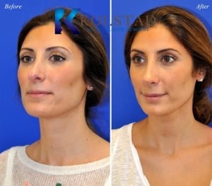Middle Eastern Nose Job Before & After San Diego