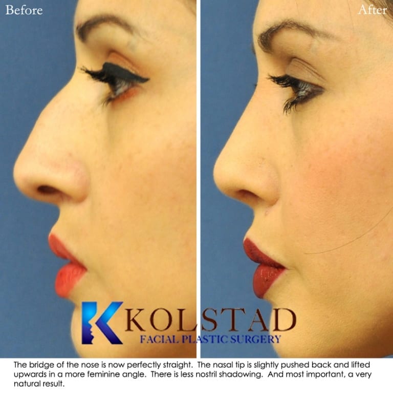 Hispanic Rhinoplasty Before & After Gallery 4 | Dr. Kolstad - San Diego