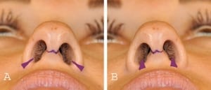 incisions-for-nostril-and-alar-base-reduction