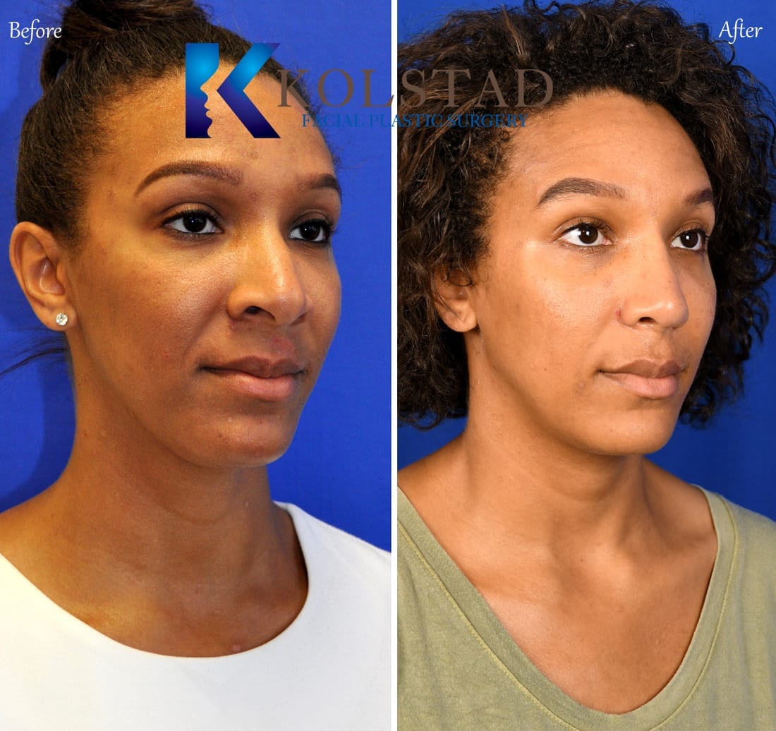 Throughout the year the nasal bridge will appear narrower and the tip of th...