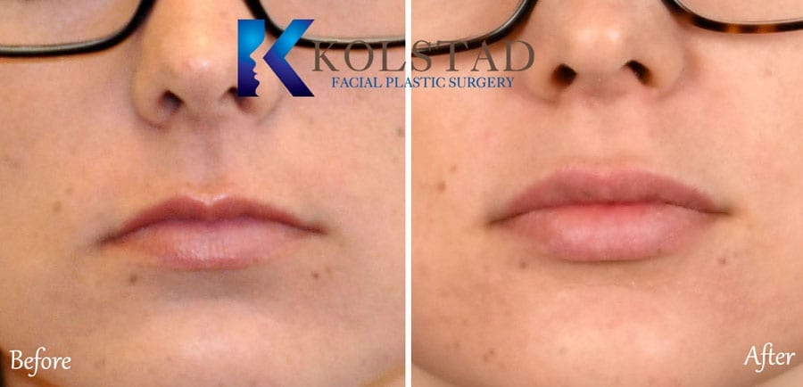 Lip Augmentation – Rocklin - Elite Medical Aesthetics - Truths thumbnail