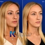 best revision nose surgery san diego