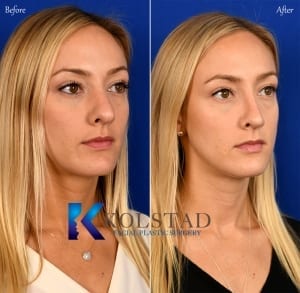 best revision nose surgery san diego