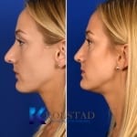 revision nose surgery san diego