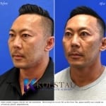 asian eyelid surgery results