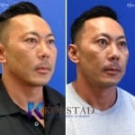 before and after asian eyelid surgery