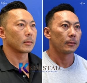 before and after asian eyelid surgery