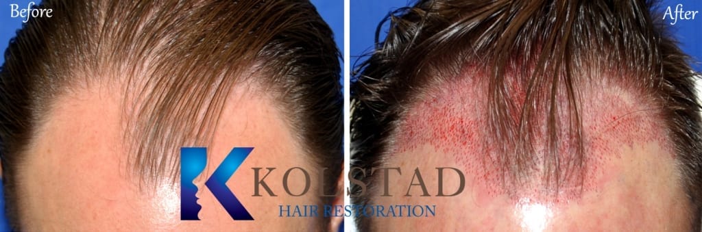 san diego neograft hair transplant