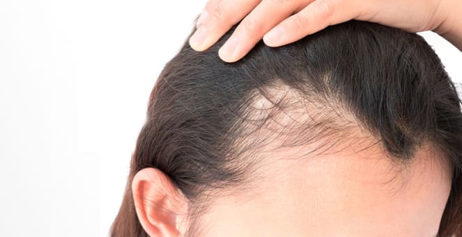 female hair loss