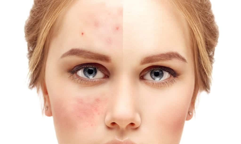 Acne scar removal san diego