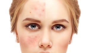 Acne scar removal san diego